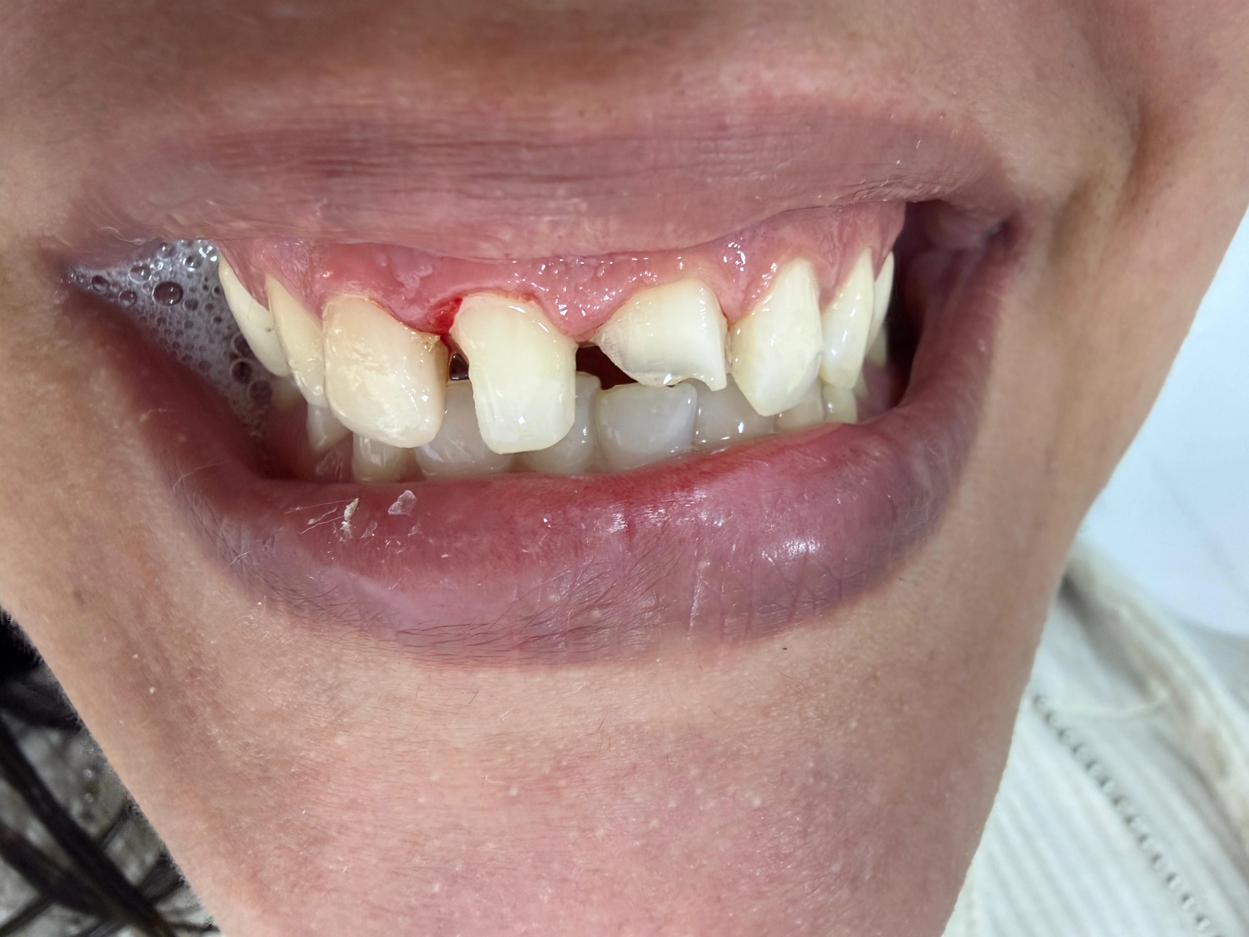 Caso clínico antes do tratamento — Dra. Marcia Maia CRO-RJ 26328