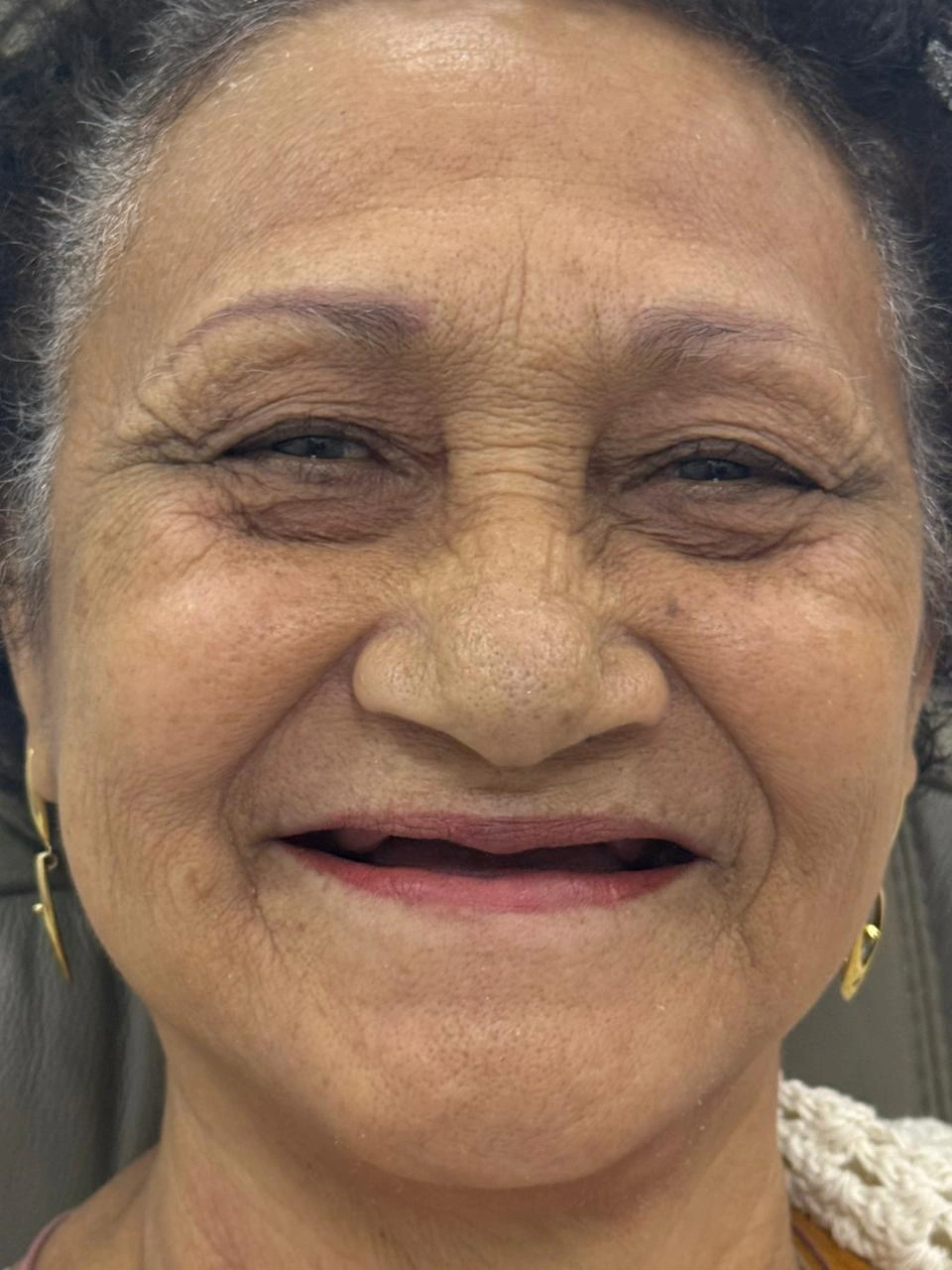 Caso clínico antes do tratamento — Dra. Marcia Maia CRO-RJ 26328