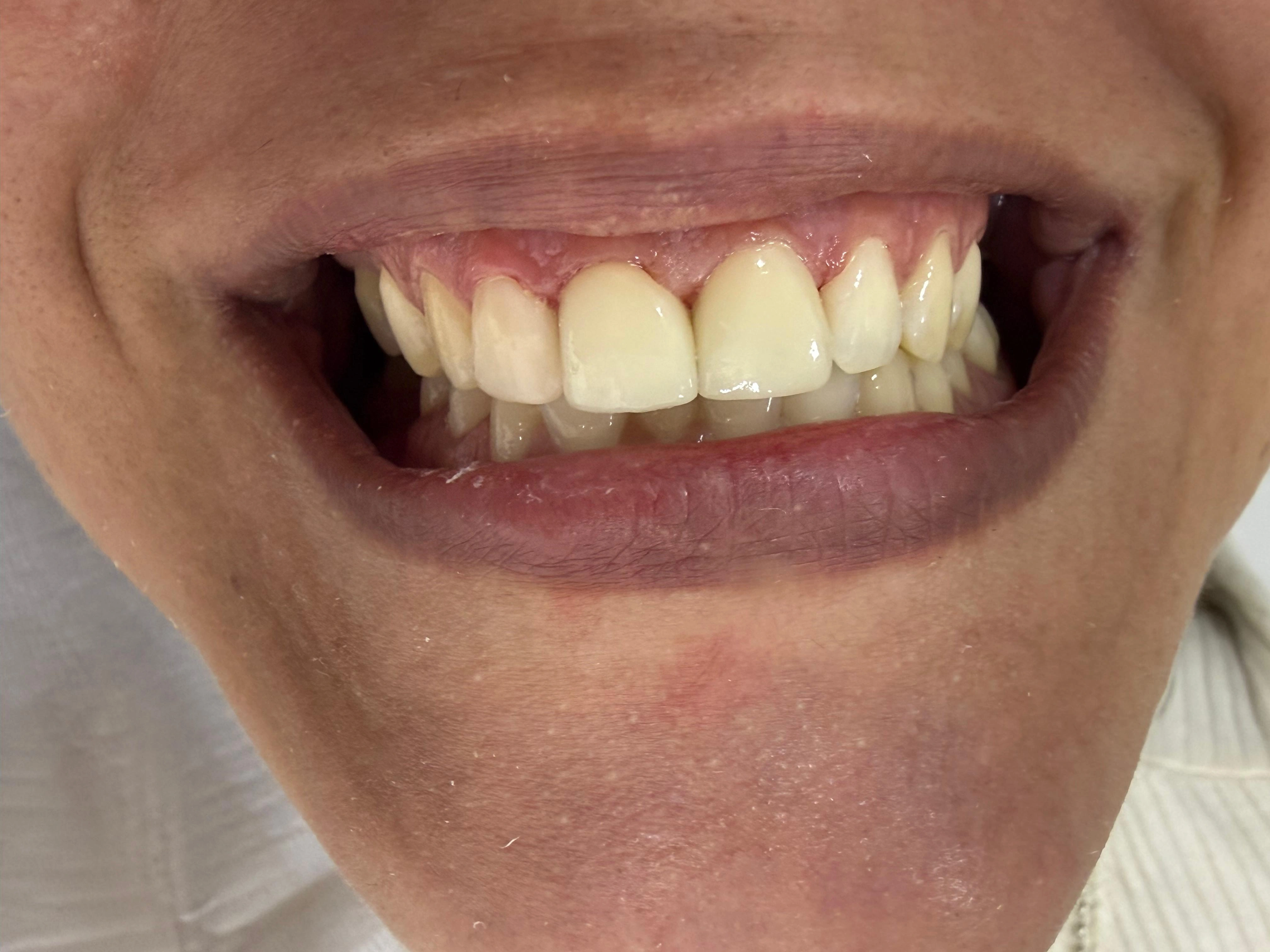 Caso clínico após o tratamento — Dra. Marcia Maia CRO-RJ 26328