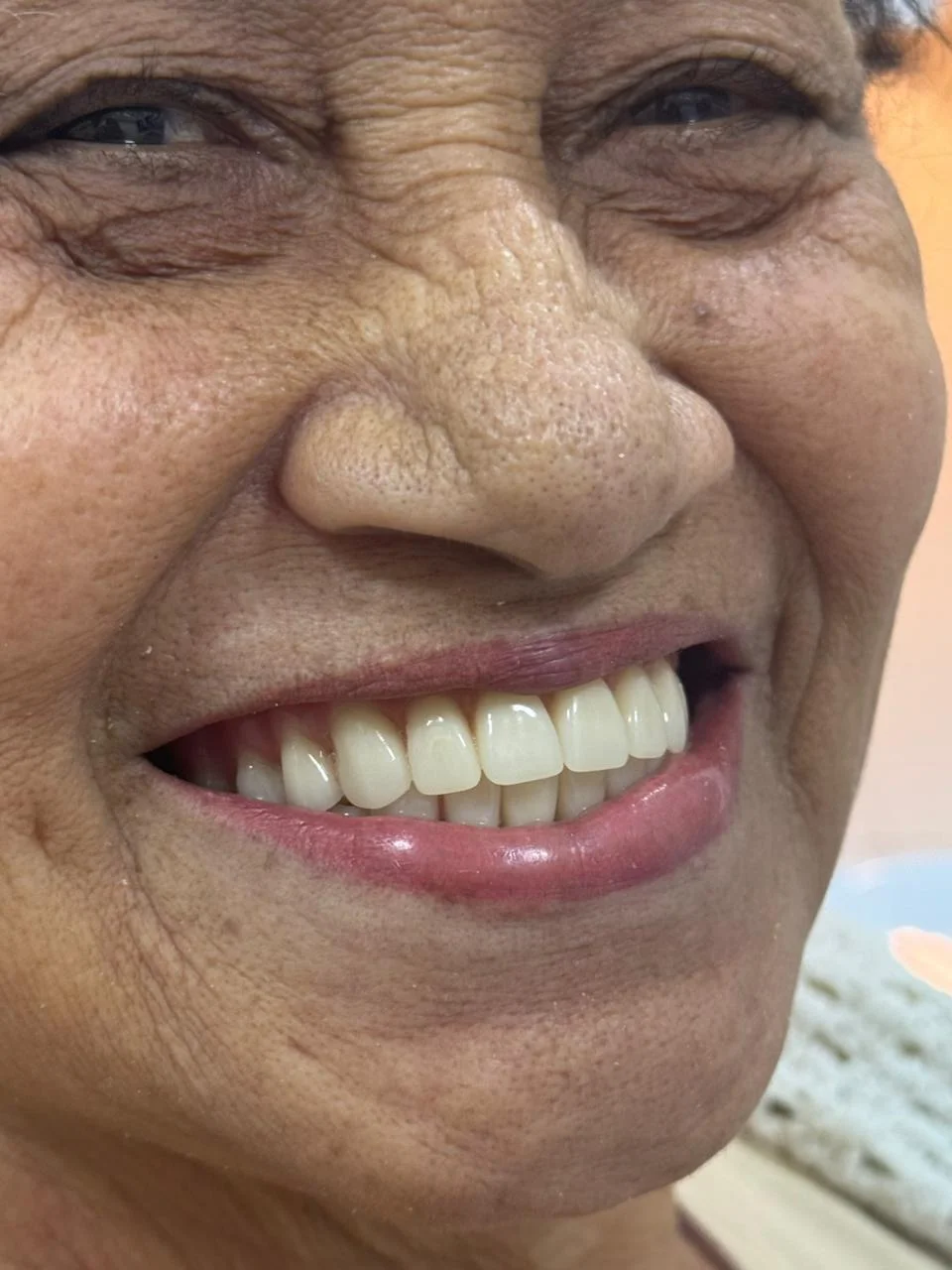 Caso clínico após o tratamento — Dra. Marcia Maia CRO-RJ 26328