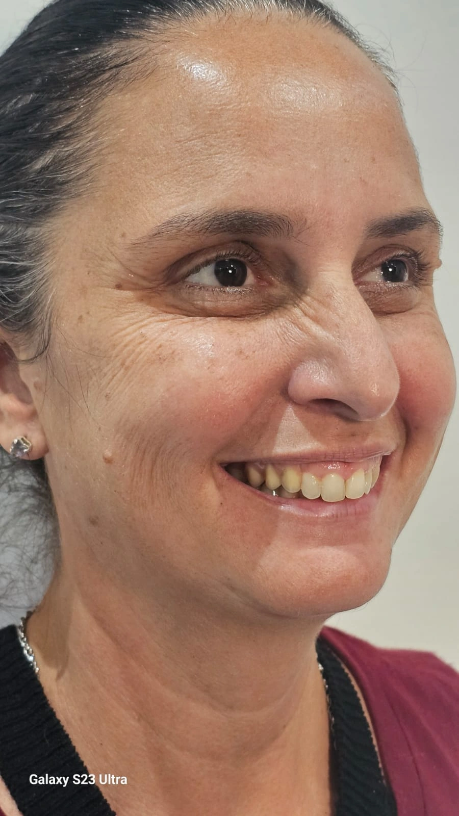 Caso clínico após o tratamento — Dra. Marcia Maia CRO-RJ 26328